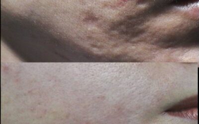 Fractional Laser: Ο Απόλυτος Οδηγός για την Ανάπλαση Δέρματος το 2026