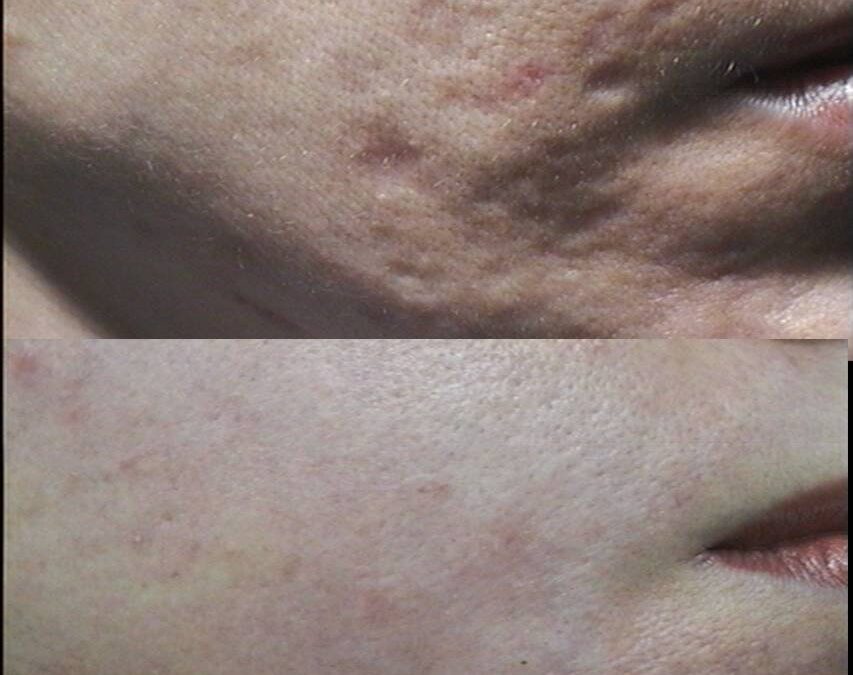 Fractional Laser: Ο Απόλυτος Οδηγός για την Ανάπλαση Δέρματος το 2026